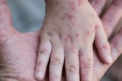 Xuất hiện ca đậu mùa khỉ đầu tiên ở TP HCM, người dân cần làm gì để phòng tránh?
