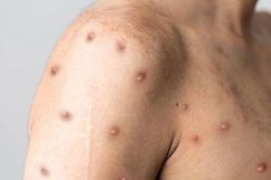 TP.HCM phát hiện ca đậu mùa khỉ đầu tiên