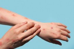 Cập nhật tình hình sức khỏe ca đậu mùa khỉ đầu tiên ở TP.HCM: Bệnh nhân đã âm tính