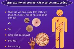 Khuyến cáo phòng chống đậu mùa khỉ với hành khách nhập cảnh Việt Nam