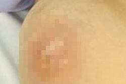 Tự ý mua thuốc về tiêm, người phụ nữ ở Hải Dương phải nhập viện điều trị