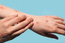 Đà Nẵng xây dựng 3 tình huống ứng phó với bệnh đậu mùa khỉ