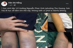 Học sinh lớp 1 ở Đà Nẵng tay chân bầm tím sau buổi học