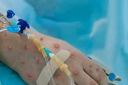 Chủ động ứng phó, giám sát bệnh đậu mùa khỉ