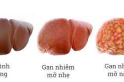 Một số thuốc có thể gây gan nhiễm mỡ...