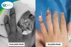 Trẻ suýt đứt rời ngón tay khi giúp anh nấu cơm