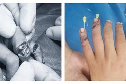 Bảo toàn ngón tay gần đứt rời cho bé 7 tuổi