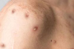 Việt Nam khống chế được ca bệnh đậu mùa khỉ đầu tiên