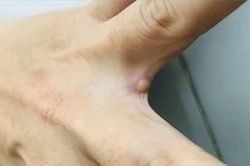 TP HCM: Ghi nhận ca mắc đậu mùa khỉ thứ hai