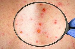 Ca bệnh đậu mùa khỉ thứ hai có khả năng lây ra cộng đồng không?