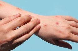 TPHCM ghi nhận ca mắc đậu mùa khỉ thứ hai