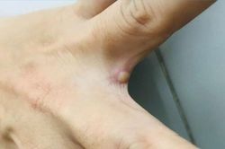 TP.HCM ghi nhận ca mắc đậu mùa khỉ thứ hai