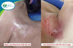 Bé gái bị bỏng do hóa chất tẩy dầu mỡ