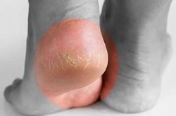 Nứt gót chân kéo dài cảnh báo bất ổn gì ở cơ thể?