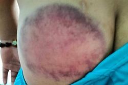 Thổi bong bóng trong giờ học, nam sinh lớp 4 bị thầy đánh tím mông