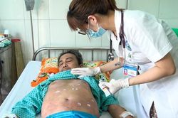 Nhiễm trùng nặng do tự chích vỡ mụn nước khi bị viêm da cơ địa