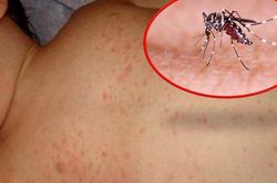 Lưu ý cách chăm sóc bệnh nhân sốt xuất huyết tại nhà