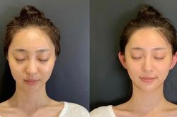 Bình luận trái chiều về trào lưu thẩm mỹ 'tai yêu tinh'