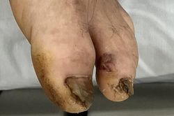 Bị cọc nhọn đâm vào chân, cụ ông nguy kịch do mắc căn bệnh có nguy cơ tử vong lên đến 95%