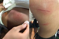 Xác minh vụ nam thanh niên bị chém nhầm ở TP Thủ Đức