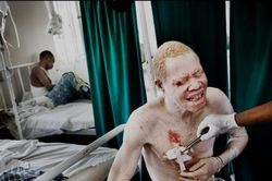 Người bạch tạng từng bị phân biệt đối xử và 'săn lùng' ra sao?