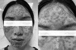 Nhiều cô gái trẻ phải nhập viện do đắp mặt, bôi kem detox