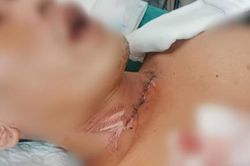 Thanh niên nghi bị dây diều cuốn vào cổ té xuống, phải tháo khớp ngón tay