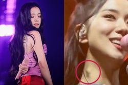 Jisoo Blackpink khiến fan lo lắng với khối u trên cổ