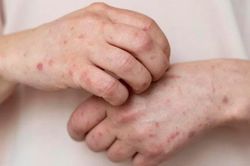 Người đàn ông nghi mắc đậu mùa khỉ sau chuyến du lịch nước ngoài, Bộ Y tế chỉ đạo khẩn