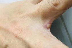Đắk Lắk có ca nghi mắc đậu mùa khỉ đi du lịch từ nước ngoài về