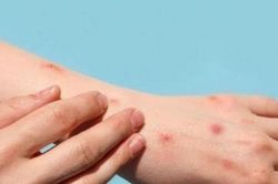 Sở Y tế Đắk Lắk chỉ đạo 'nóng' sau khi có người nghi mắc đậu mùa khỉ