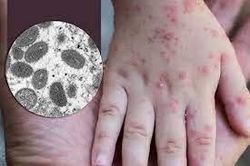 Sẵn sàng ứng phó với dịch bệnh đậu mùa khỉ