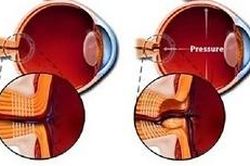 Nhận biết bệnh glôcôm - Kẻ cắp ánh sáng thầm lặng