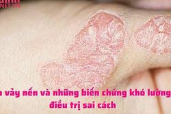 Bệnh vảy nến và những biến chứng khó lường khi điều trị sai cách