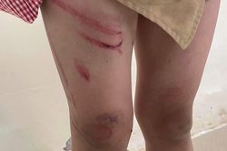 Bé trai 7 tuổi sống với mẹ và 'bố dượng' bị đánh tím bầm ở Hải Phòng