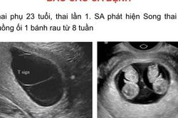 Cực hiếm: Công bố ca bệnh song thai cùng trứng nhưng khác nhau về kiểu hình và kiểu gene