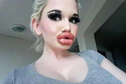 Dù nguy hiểm đến tính mạng, cô gái vẫn tiêm filler môi 32 lần
