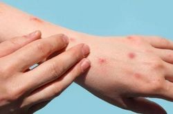 Bộ Y tế đưa đậu mùa khỉ vào bệnh truyền nhiễm nhóm B