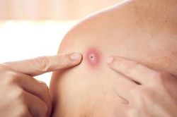 Đậu mùa khỉ được xếp vào bệnh truyền nhiễm nguy hiểm