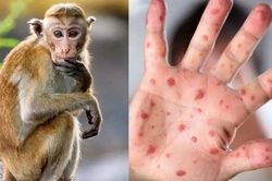 Bộ Y tế đưa đậu mùa khỉ vào danh mục bệnh truyền nhiễm nhóm B