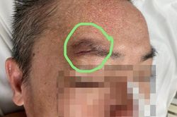 Chạy đua với thời gian cứu bệnh nhân uốn ván