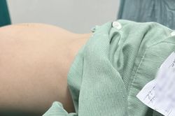 Bé gái 12 tuổi mang khối u buồng trứng 'khổng lồ'
