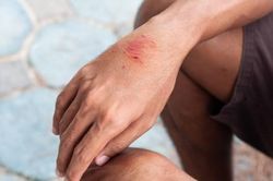 Người đàn ông ở Hà Nội tử vong sau 2 tháng bị chó cắn