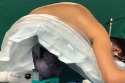 Người đàn ông hơn 10 năm không thể nằm ngửa được phẫu thuật hết gù