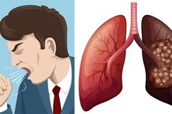 Dấu hiệu ban đầu của ung thư phổi