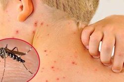 Số mắc sốt xuất huyết đã vượt 300.000 ca, lưu ý quan trọng để tránh bệnh diễn biến nặng