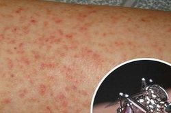 Số người mắc sốt xuất huyết vượt 300.000 ca, 112 trường hợp tử vong