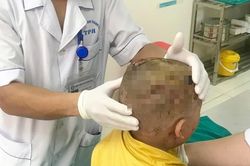 Bé 2 tuổi bị chó cắn trọng thương