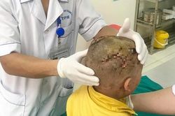 Bé 2 tuổi ở Thanh Hóa đang chơi bỗng nhiên bị chó cắn tổn thương nghiêm trọng vùng mặt
