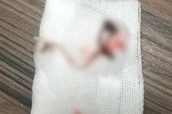 Hy hữu người phụ nữ ăn cá bị hóc lưỡi câu, nhập viện khẩn